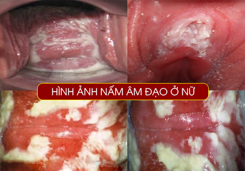 hình ảnh nấm âm đạo