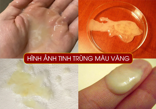 hình ảnh tinh trùng màu vàng