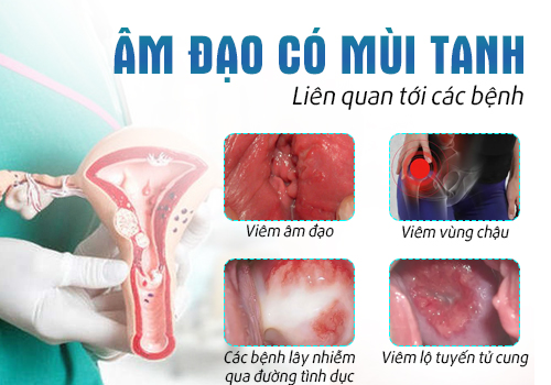 âm đạo có mùi tanh