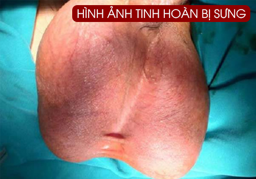 hình ảnh tinh hoàn bị sưng