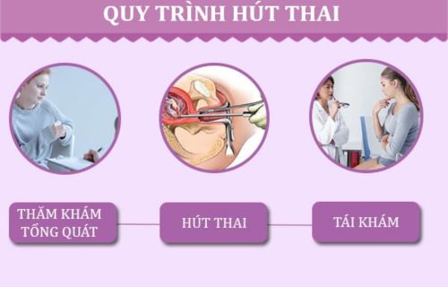 Quy trình thực hiện hút thai